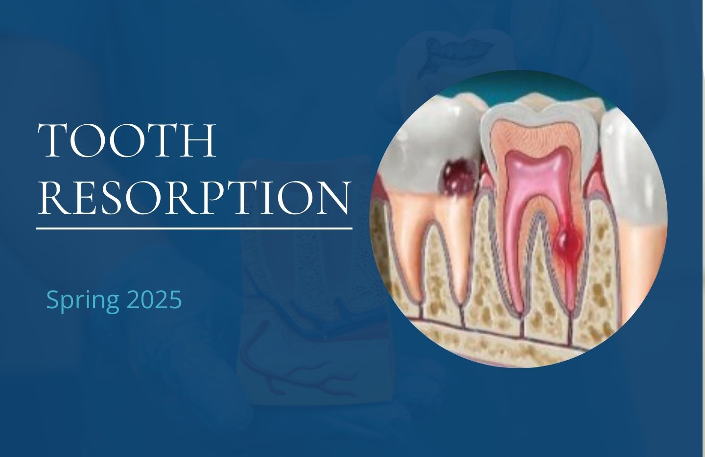 Tooth Resorption